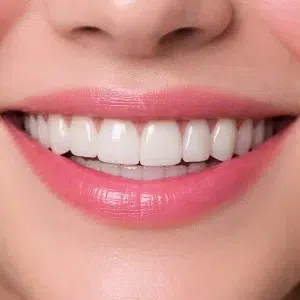 لمینیت دیجیتال کلینیک دندانپزشکی شادان