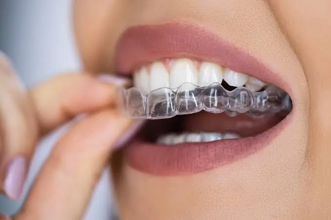 نمونه درمان با Aligner