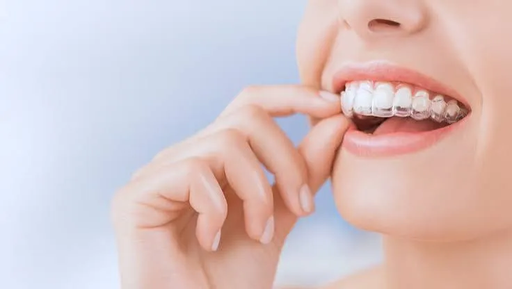 پلاک شفاف ارتودنسی