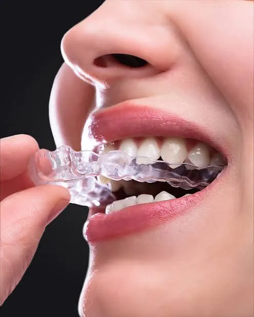 نمونه طراحی درمان Aligner