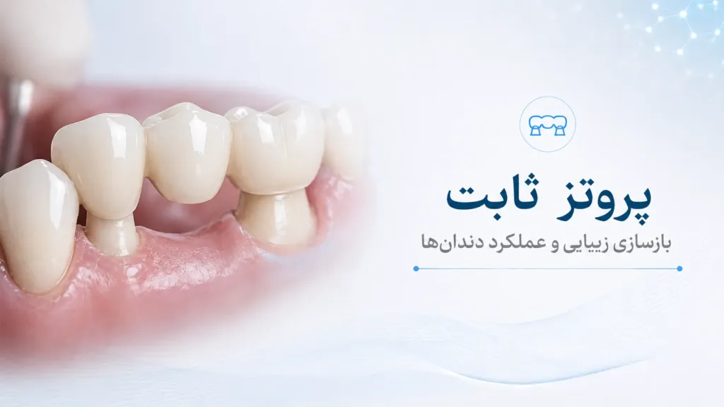 پروتز ثابت