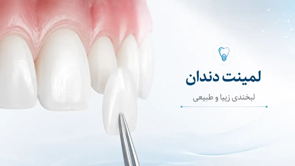 لمینت