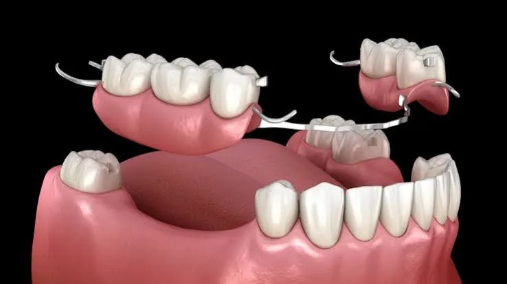 نمونه پروتز متحرک شماره 8