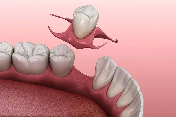 نمونه پروتز متحرک شماره 2