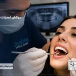 روکش ایمپلنت دندان در کرج