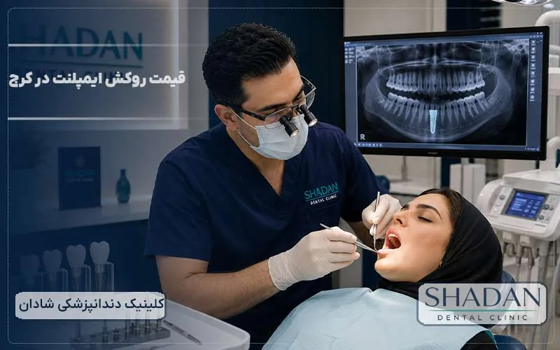 قیمت روکش ایمپلنت در کرج