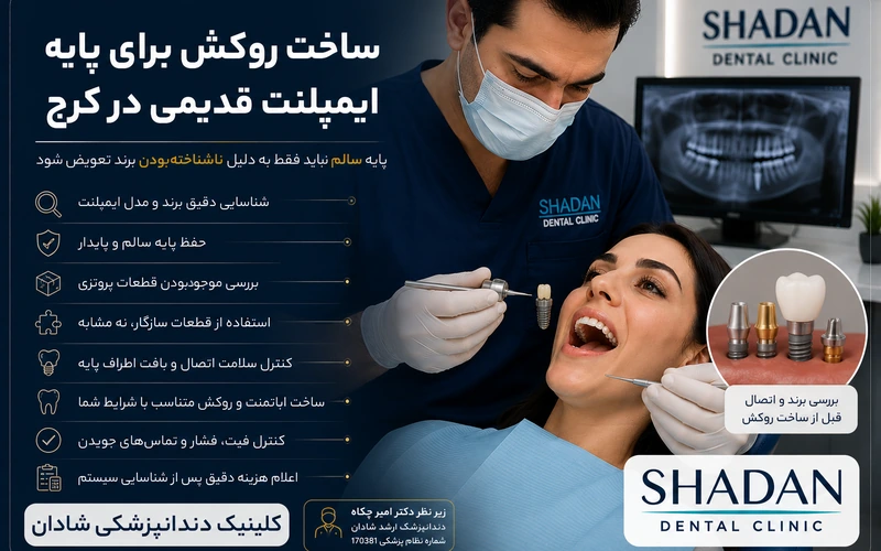 ساخت روکش برای پایه ایمپلنت قدیمی در کرج