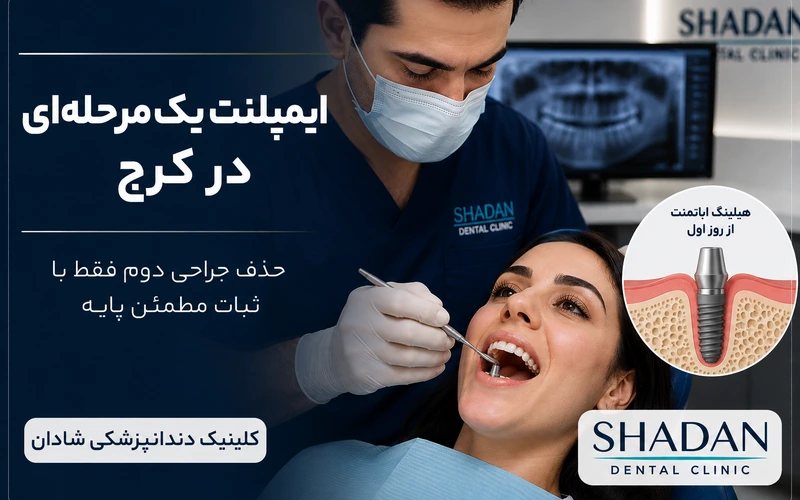 ایمپلنت یکمرحلهای در کرج