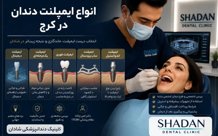 انواع ایمپلنت دندان در کرج