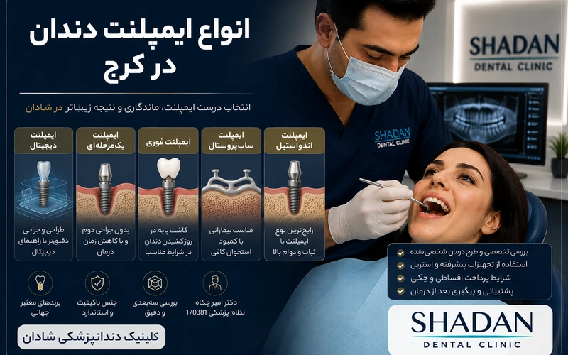 انواع ایمپلنت دندان در کرج