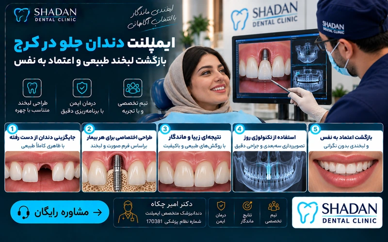 ایمپلنت دندان جلو در کرج
