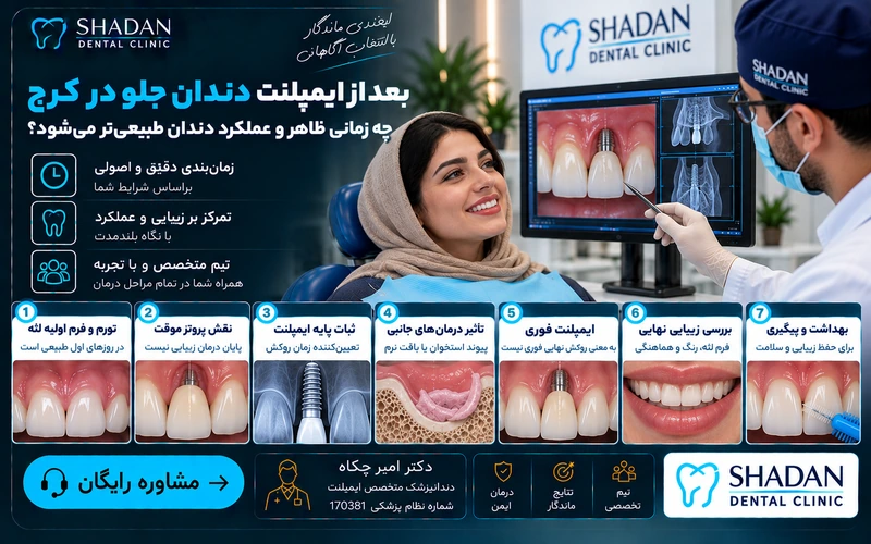 بعد از ایمپلنت دندان جلو چه زمانی ظاهر و عملکرد دندان طبیعی‌تر می‌شود؟