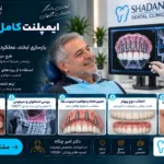 ایمپلنت کامل فک بالا در کرج