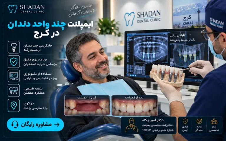 ایمپلنت چند واحد دندان در کرج 1